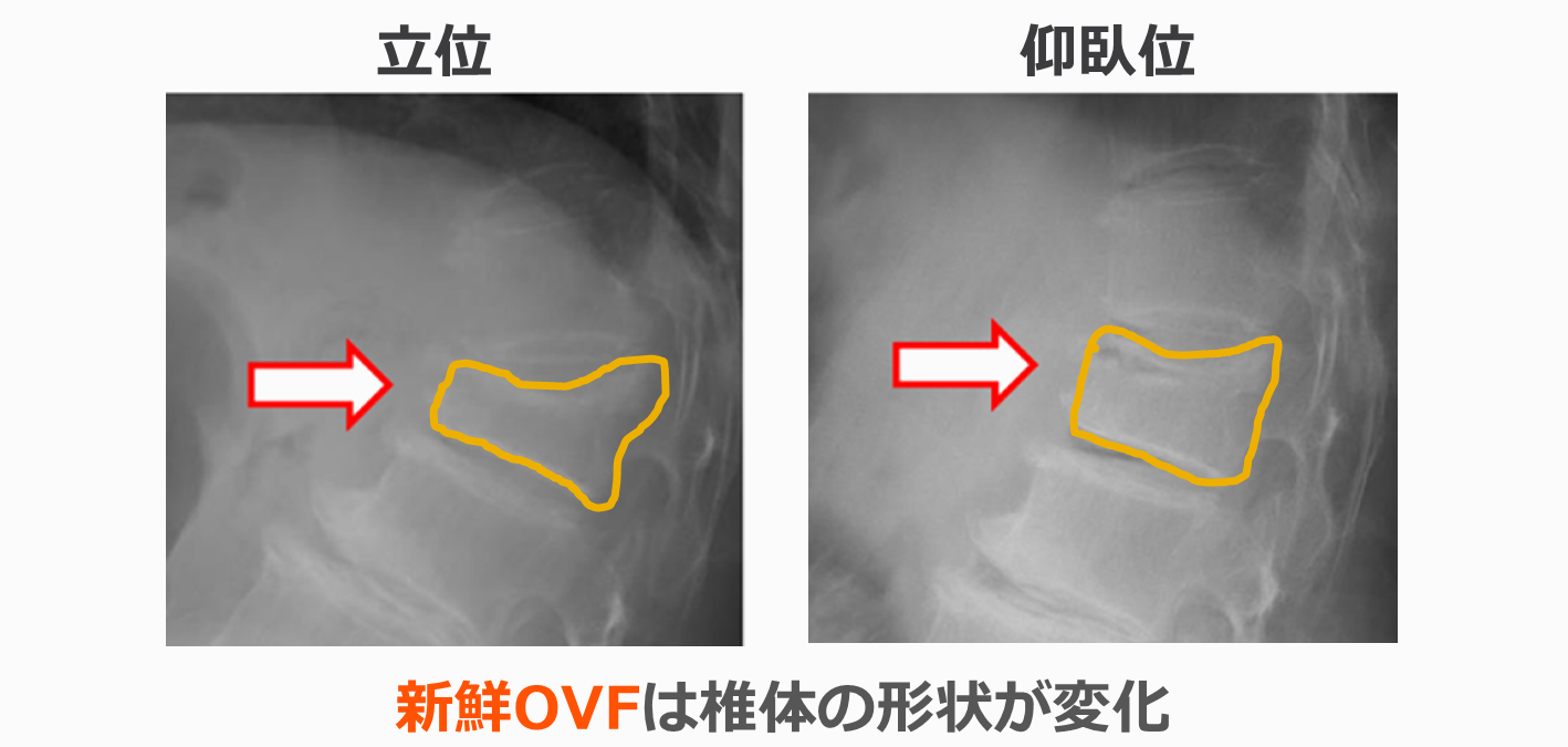 体位別画像比較の概念図